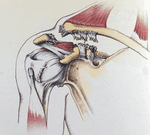 AC Joint Grade 3 Tear.WEB