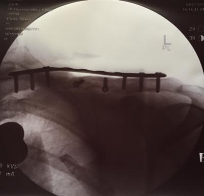 ClavicleRepair.2016.WEB